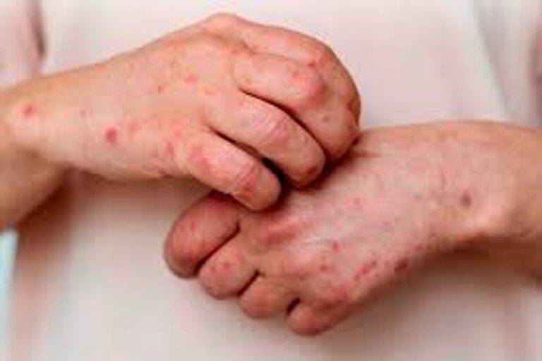 Argentina suma 3 nuevos casos de Mpox y alcanza un total de 11